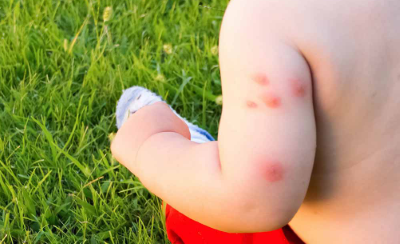 Baby Bed Bug Bites Pictures