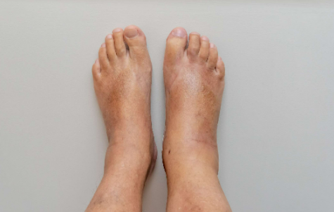 Pictures of Swollen Ankles Due to Congestive Heart Failure