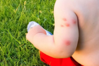 How to Treat Bed Bug Bites on Babies or Child