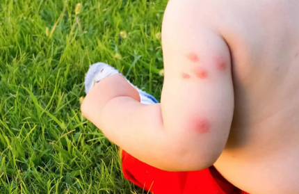 How to Treat Bed Bug Bites on Babies or Child